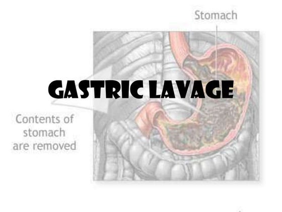 Gastric lavage