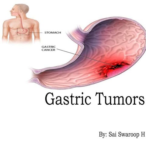Gastric tumors- By Sai Swaroop H