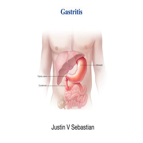 Gastritis.pdf