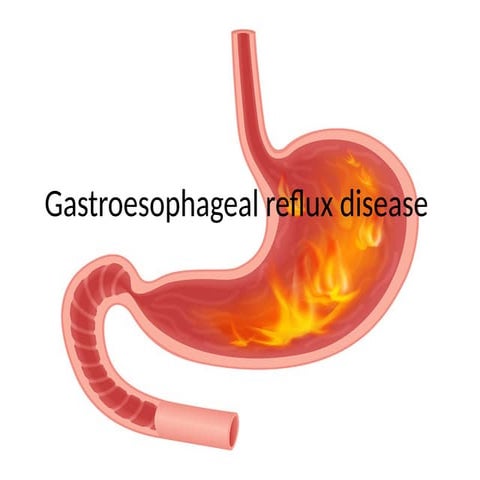 Gastroesophageal reflux disease and itsnursingmanagement .pptx