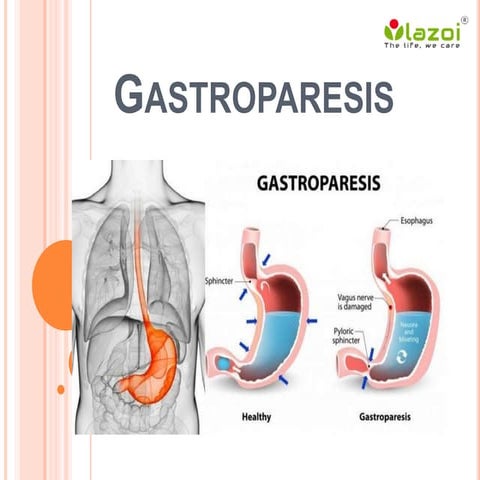 Gastroparesis: Causes, Symptoms, Diagnosis and Treatment