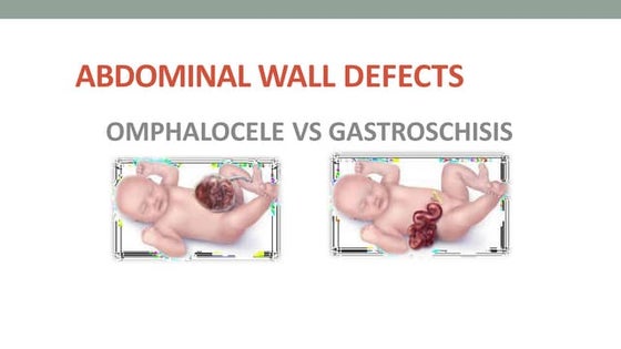 omphalocele-vs-gastroschisis-pptx-pregnancy-reproductive-health