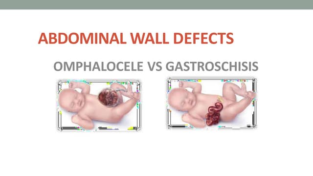Abdominal wall defect | PPTX