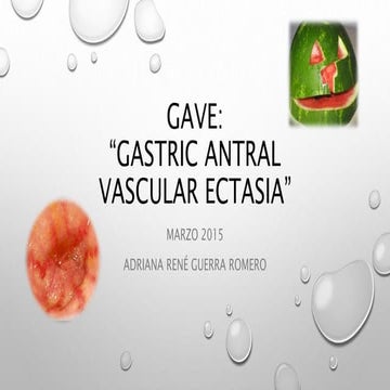 GASTRIC ANTRAL VASCULAR ECTASIA