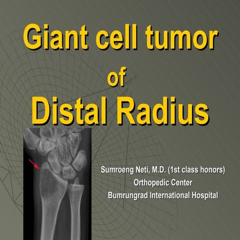 Gct of distal radius | PPT