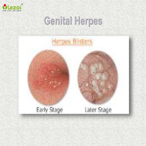 Genital herpes