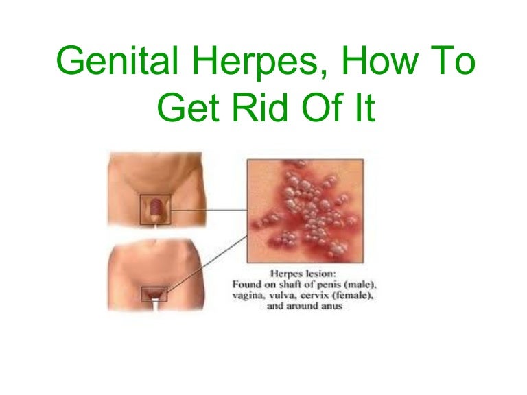 Herpes genitaler Genital herpes