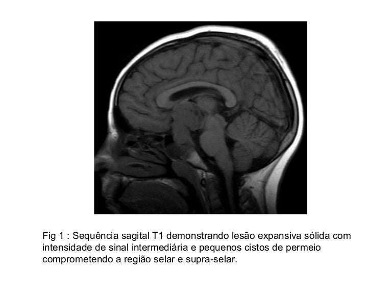 Germinoma