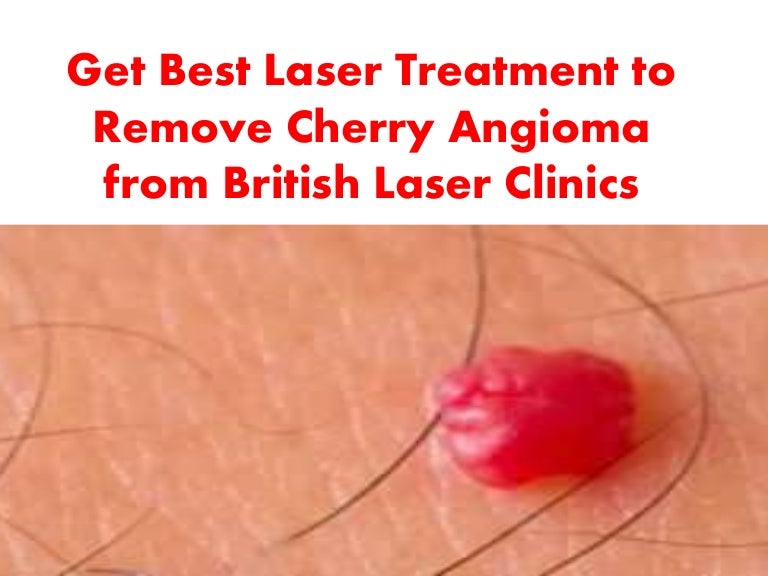 Joao Pedro Felipe Cherry Angioma Removal DIY Mole and Cherry Angioma