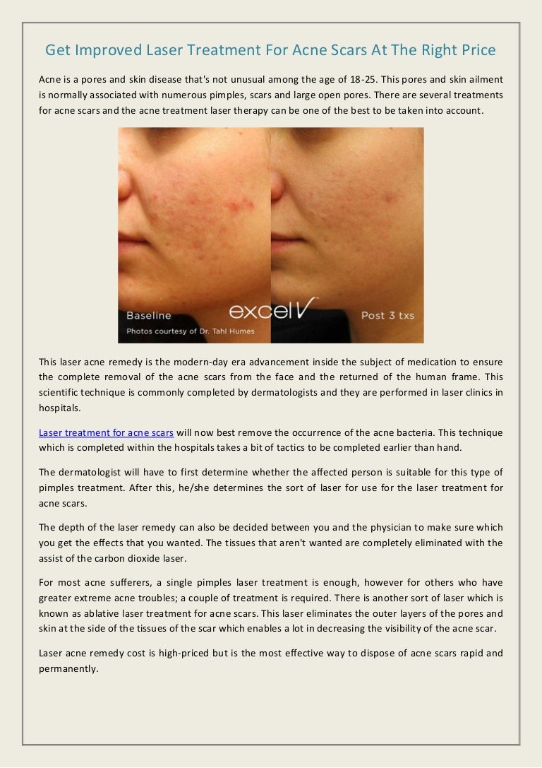 laser treatment for acne scars cost