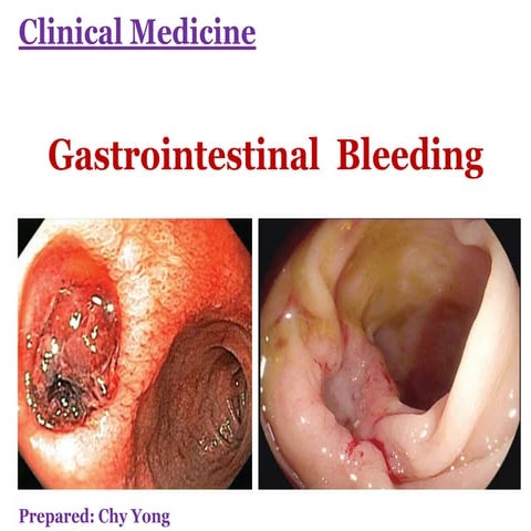GI Bleeding (Upper and Lower GIB)