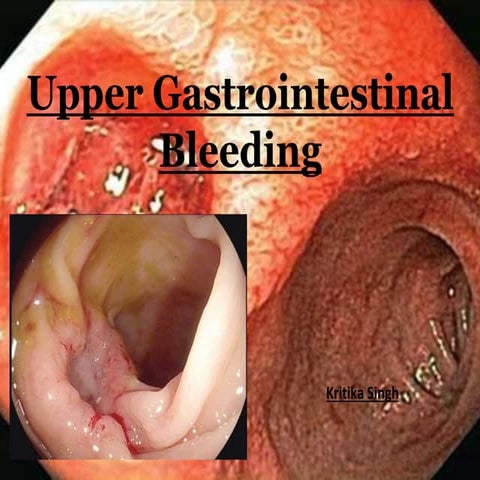 Upper GI bleeding