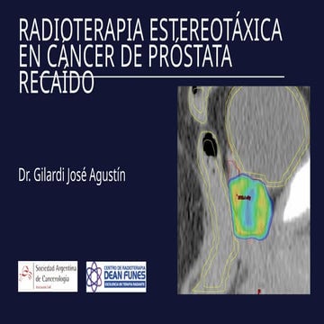 IMRT - Cáncer de próstata | PPTX