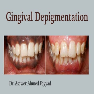 Gingival Depigmentation ............pptx