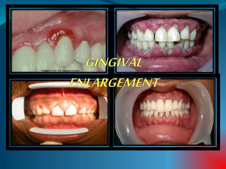 Gingival enlargement