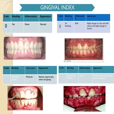 Gingival indexs | PPTX