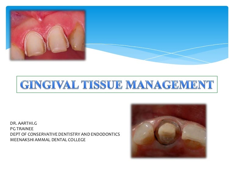Gingival tissue management