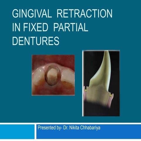Gingival tissue displacement in fpd