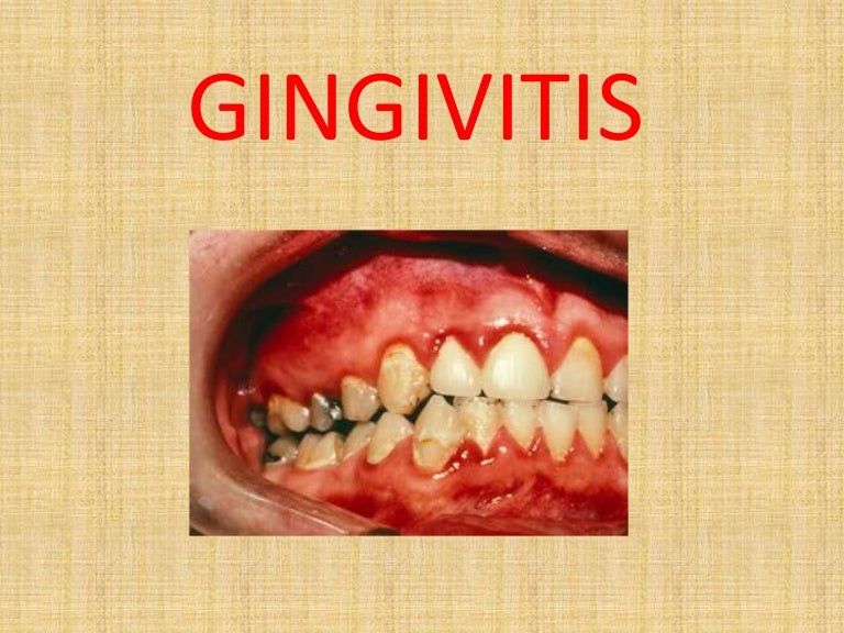 Gingivitis