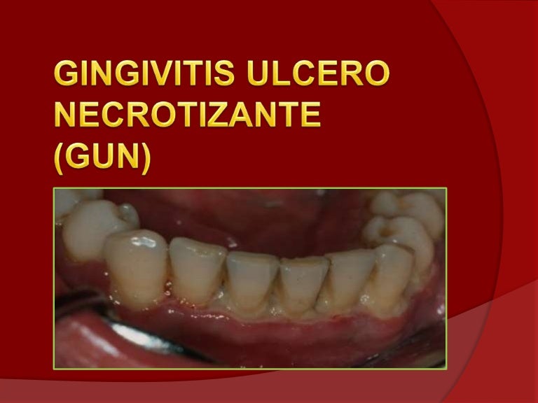 Gingivitis ulcero necrotizante (gun)