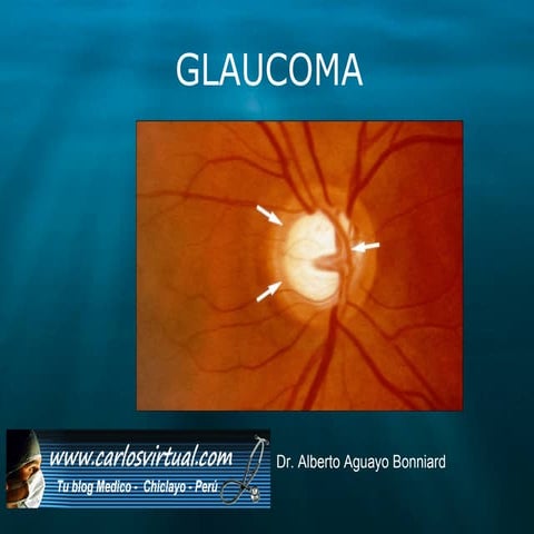 Glaucoma