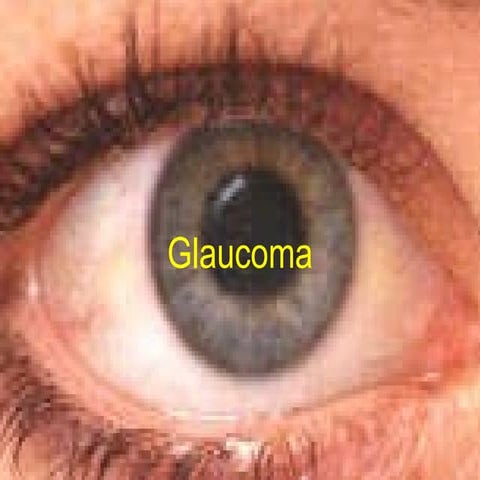 Glaucoma