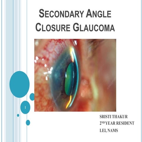 glaucoma-200919094045.pptx