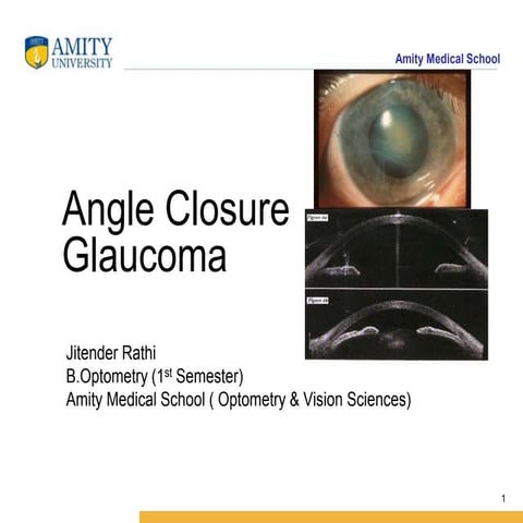 Angle Closure Glaucoma