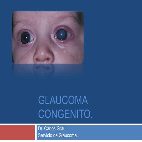 Glaucoma congenito