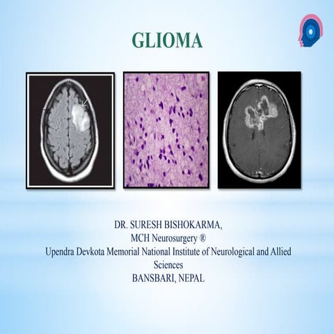 Gliomas - Brain Tumor
