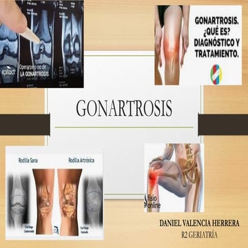 GONARTROSIS EN EL ADULTO MAYOR.ppt.pptxx | PPTX
