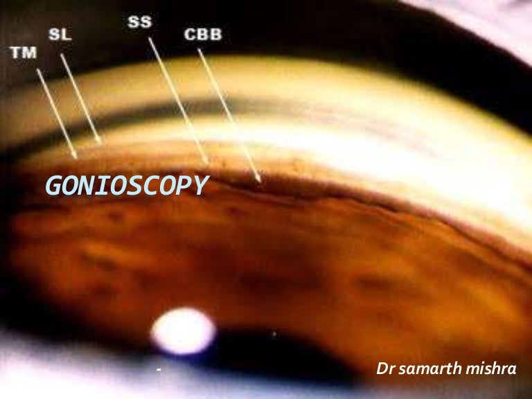 Gonioscopy gonioscopic lenses, principle and clinical aspects