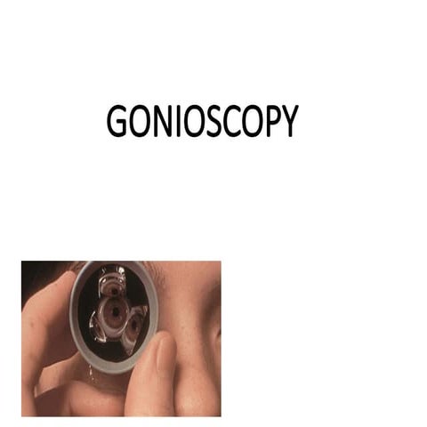 gonioscopy and its method and findings .