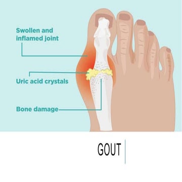 Gout | PPT