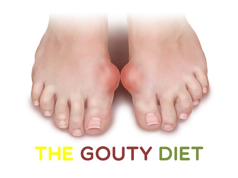 The Gouty Arthritis Diet