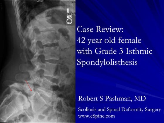 Case Review #35: 43 year old female with Adult Scoliosis and a ...