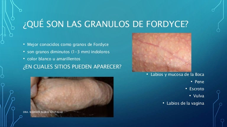 Manchas De Fordyce En El Glande Tratamiento Cómo Suprimir Las Manchas De Fordyce Pull A Fast One Remedios Caseros