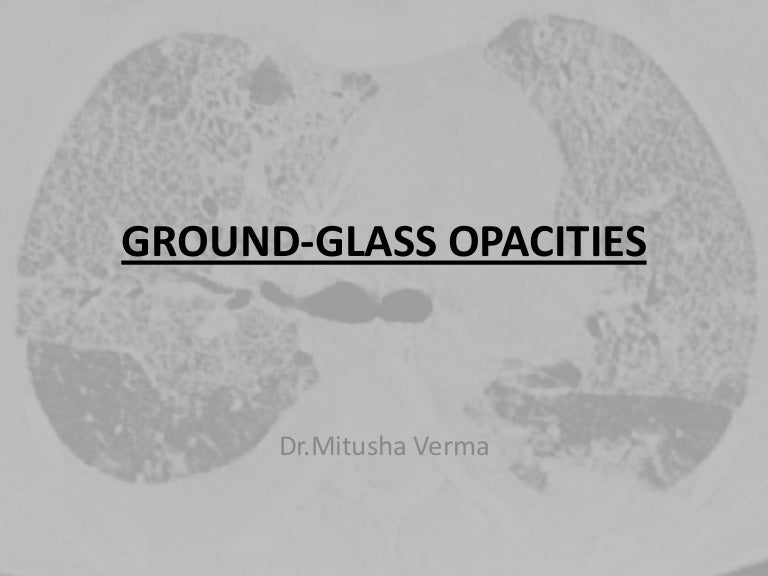 HRCT chest Ground glass opacities