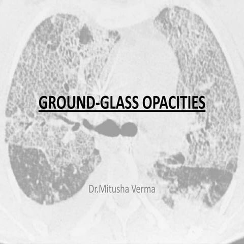 Ground-Glass Opacities: Patterns and Causes | PPT