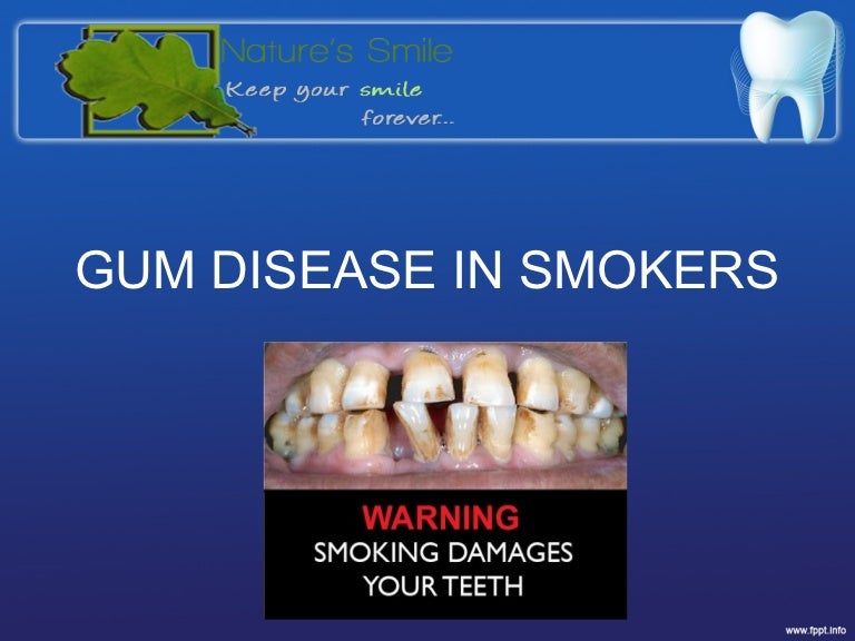 GUM DISEASE IN SMOKERS