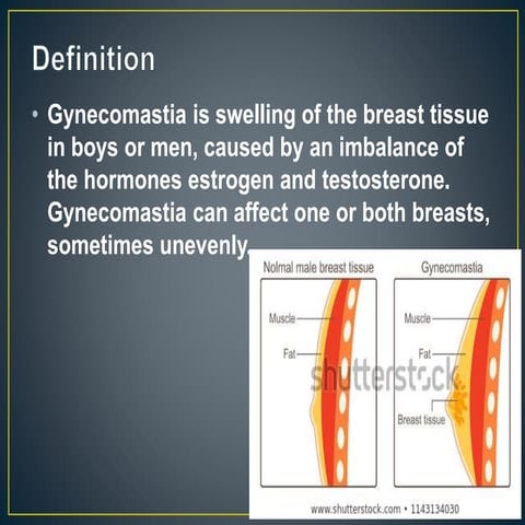 Gyneacomastia