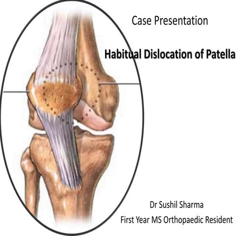 Habitual dislocation of patella