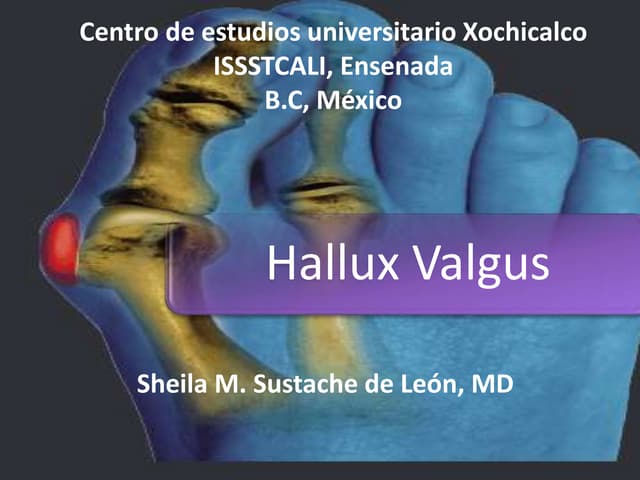 Hallux valgus