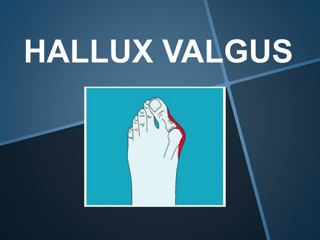 Hallux valgus