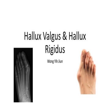 Hallux valgus | PPT