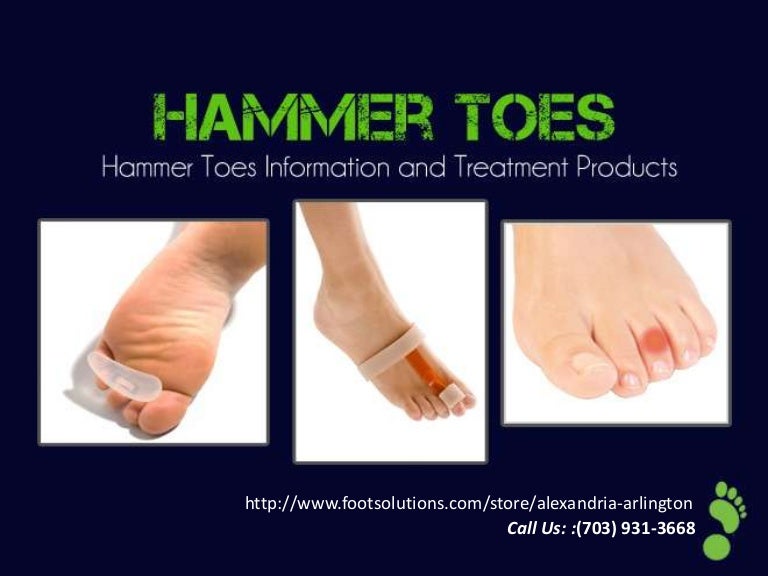 Hammer toes information & treatments