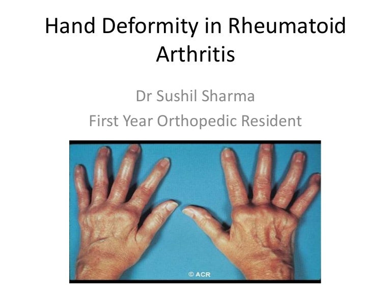 Hand deformity in rheumatoid arthritis Hand deformity in rheumatoid arthritis