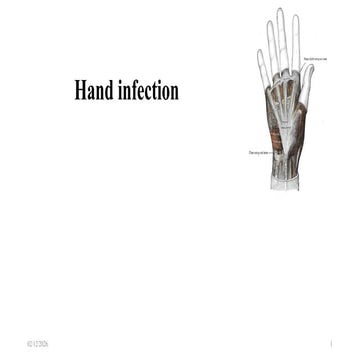 Hand infections | PPTX