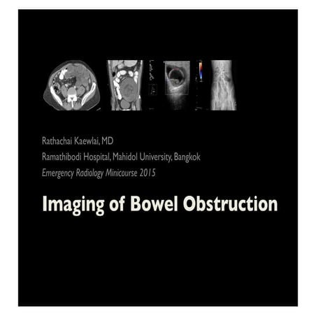 Imaging of Bowel Obstruction