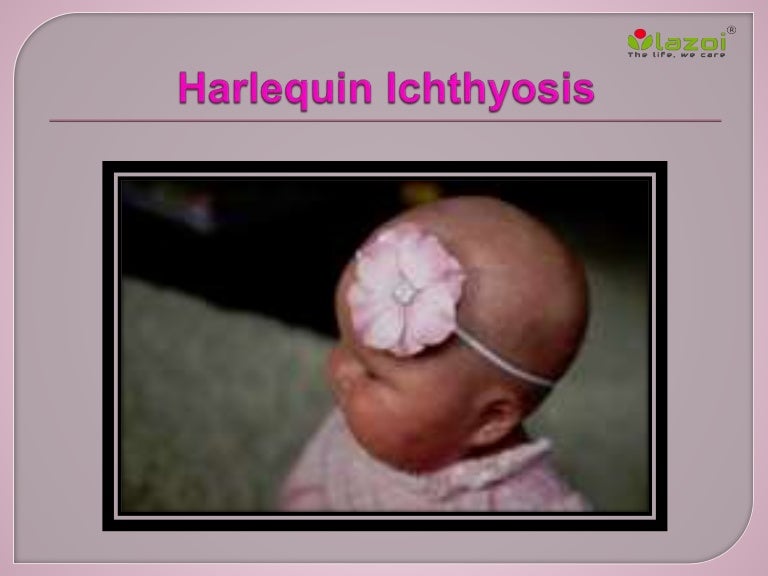 Harlequin Ichthyosis Harlequin Ichthyosis